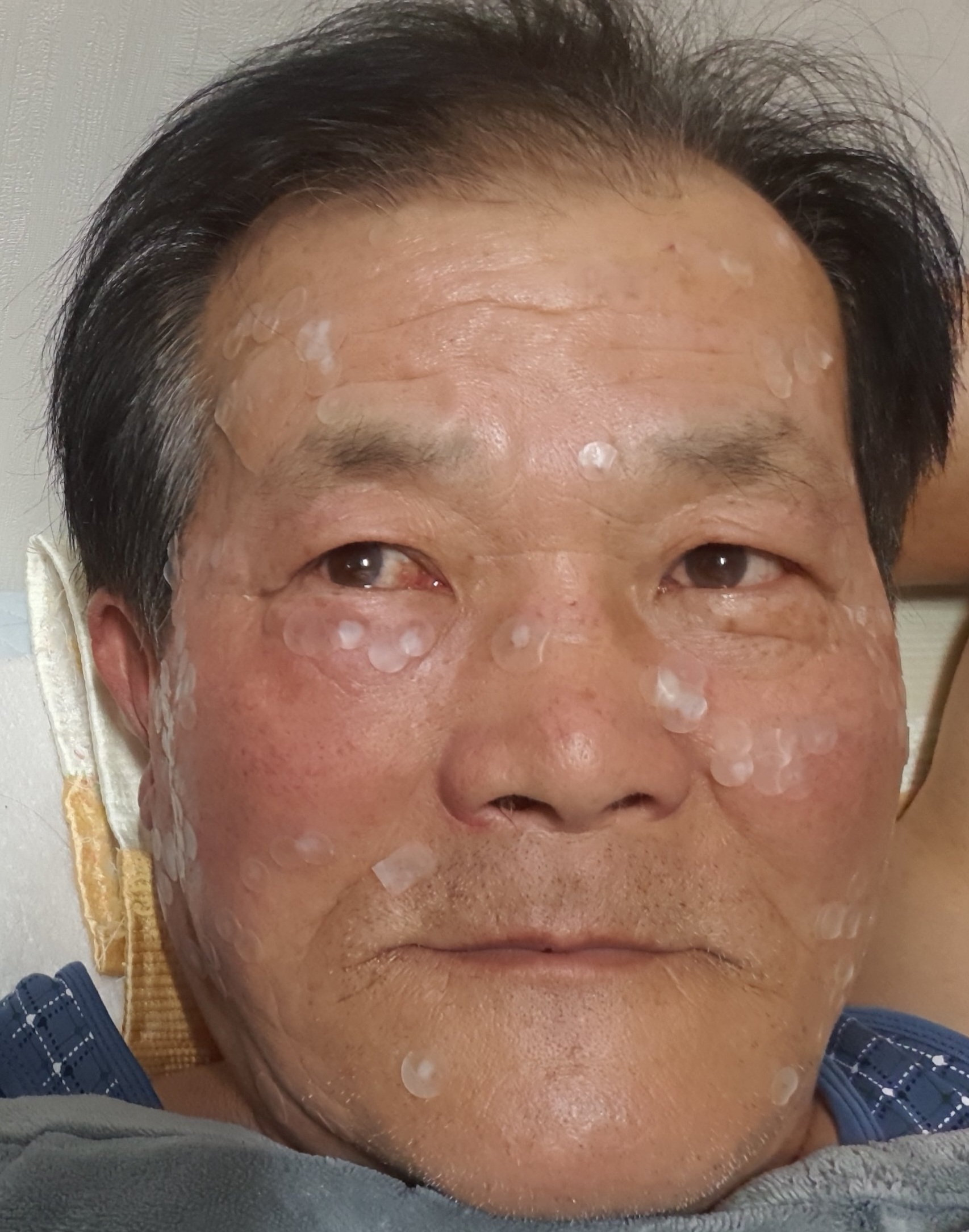 검버섯과 죽은깨